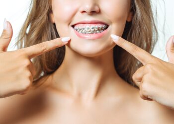 How Long Do Braces Take