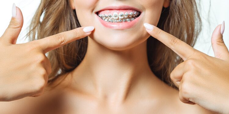 How Long Do Braces Take