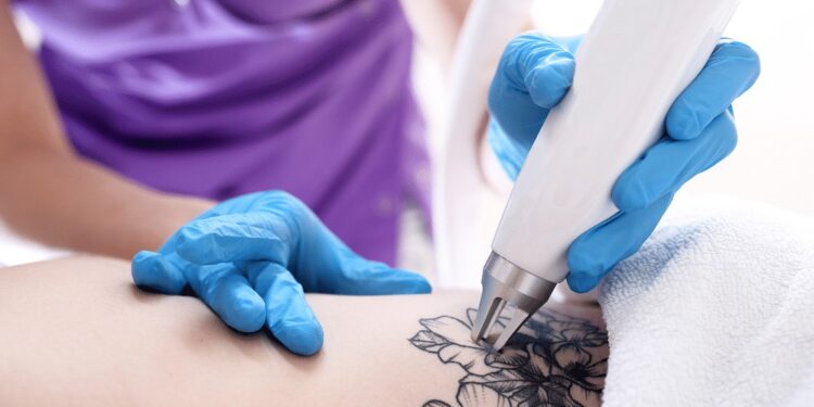 How Long Should You Wait Before Removing an Old Tattoo
