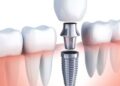 What Is the Step-by-Step Process of Getting Dental Implants?