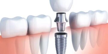 What Is the Step-by-Step Process of Getting Dental Implants?