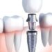 What Is the Step-by-Step Process of Getting Dental Implants?