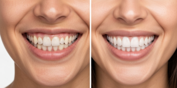 How Veneers Can Change Facial Aesthetics: Before & After Insights