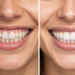 How Veneers Can Change Facial Aesthetics: Before & After Insights