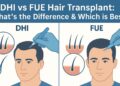 dhi hair transplant