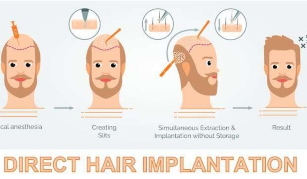 dhi hair transplant