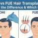 dhi hair transplant