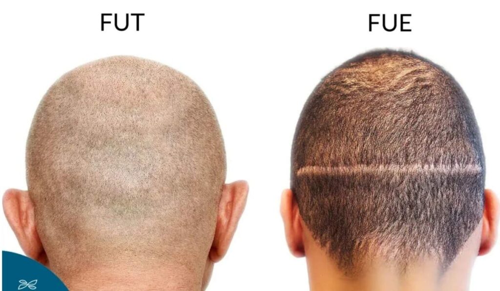 hair transplant turkey